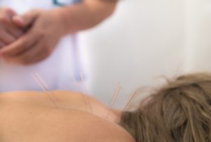 Acupuncture needles on back of a young woman