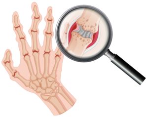 Human anatomy rheumatoid arthritis in hand illustration