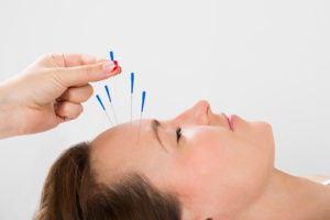 Uso de la acupuntura para la parálisis de Bell