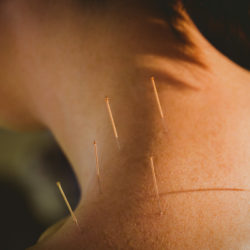 Tratamiento tendinopatía con acupuntura